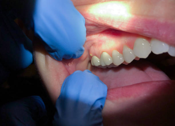 Best Emergency Cosmetic Dentistry in Fulton, NY